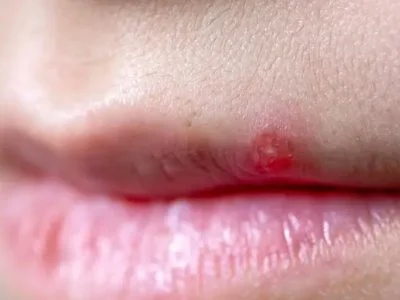 pimple on lip